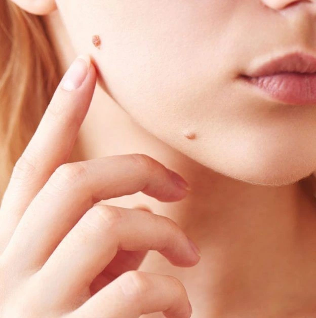 Safe removal of skin tags.